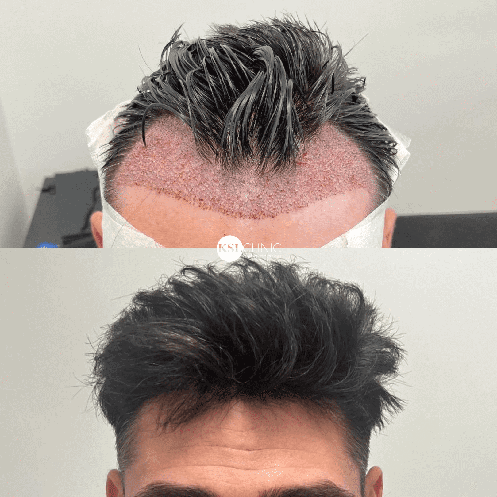 KSL-Clinic-Hair-Transplant-1