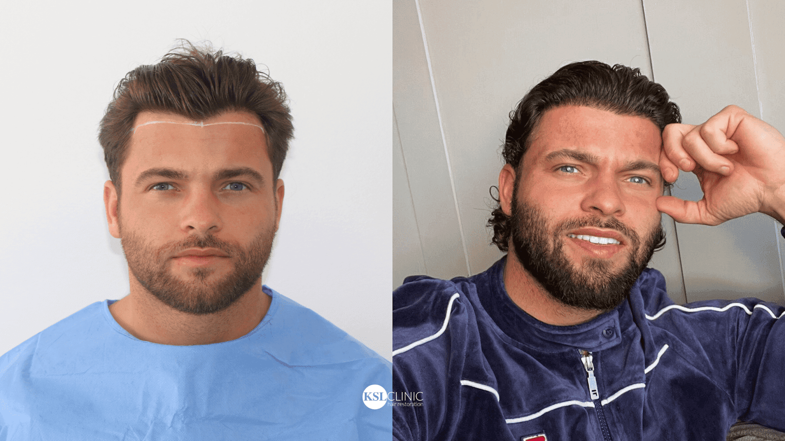 Can a hair transplant fix my receding hairline?