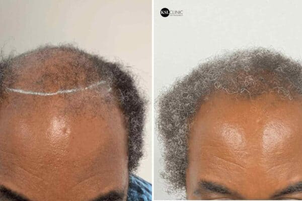 afro hair transplant before and after 2