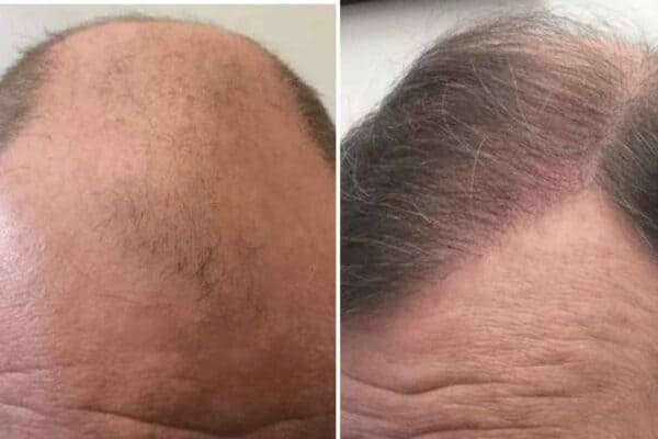 crown hair transplant before and after 3