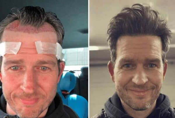 male before and after hair results
