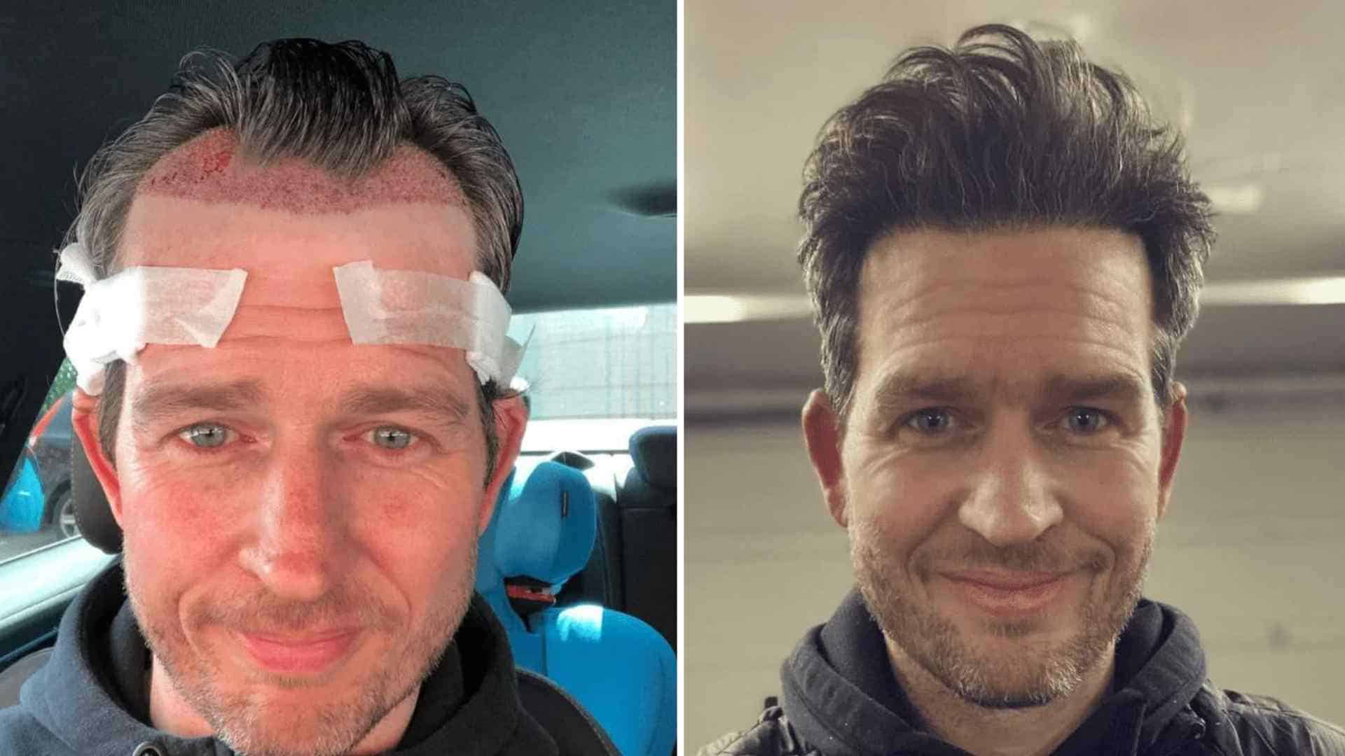 Shock Loss After Hair Transplant: Is This Normal?