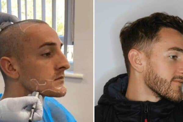 side view before and after transplant