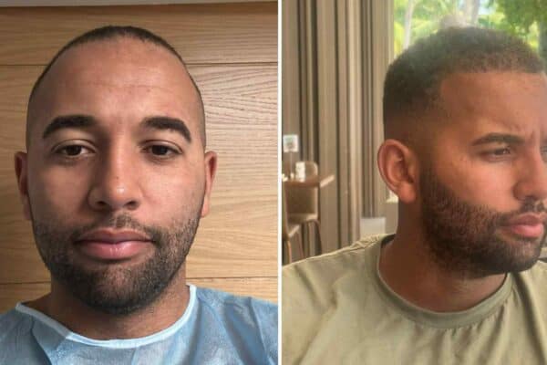 afro hair before and after hair transplant