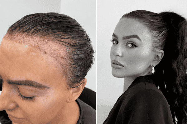 receding hairline before and after