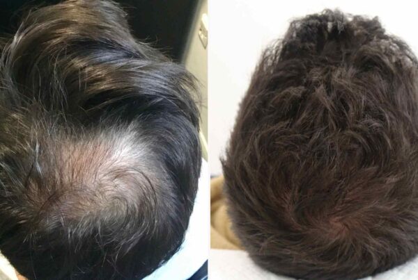 cowlick hair transplant