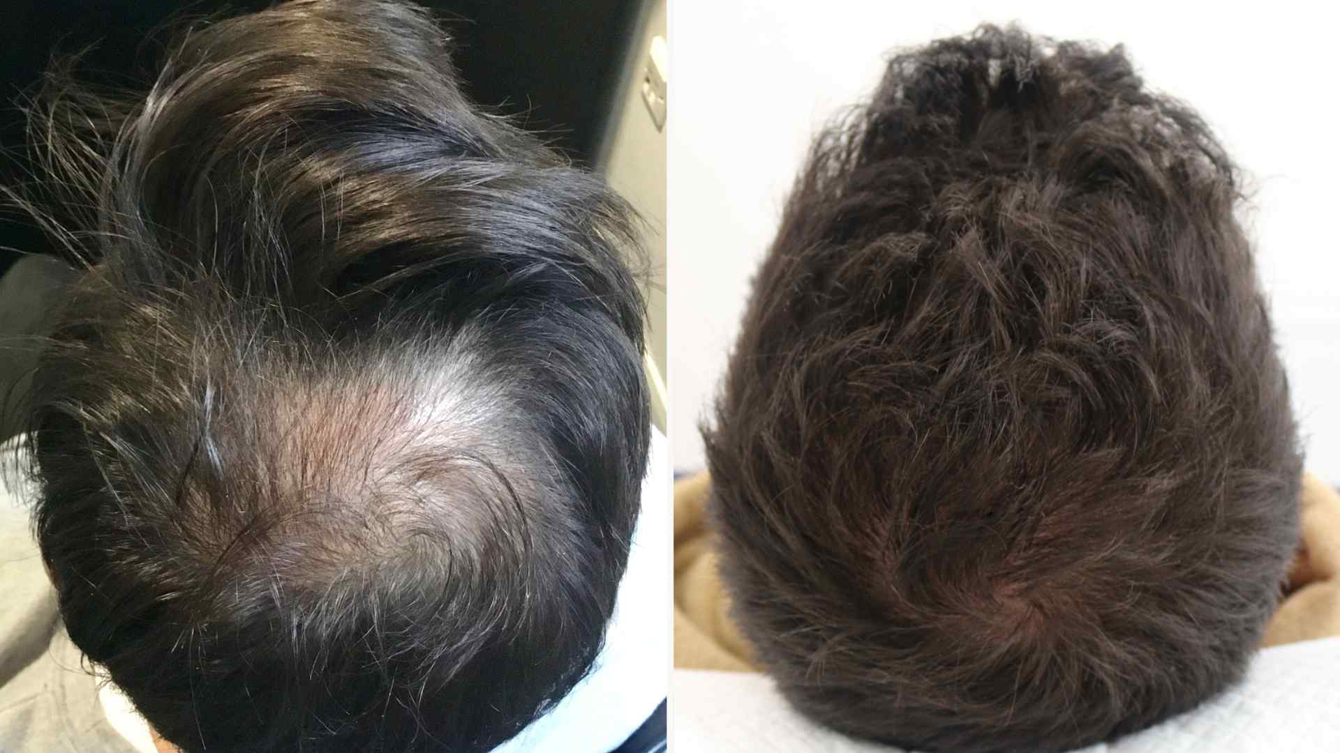 cowlick hair transplant
