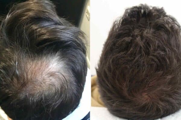 crown before and after
