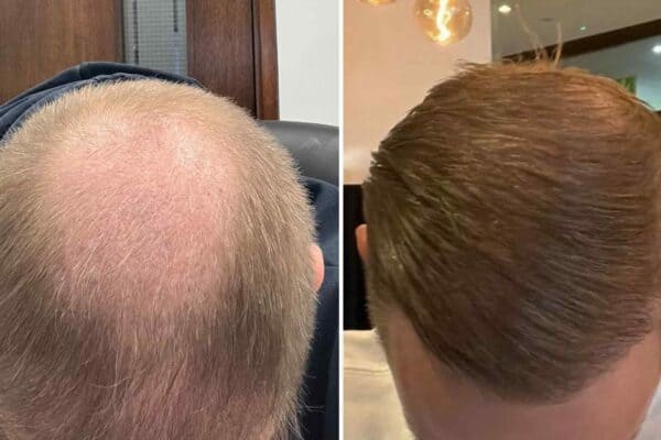 crown hair results