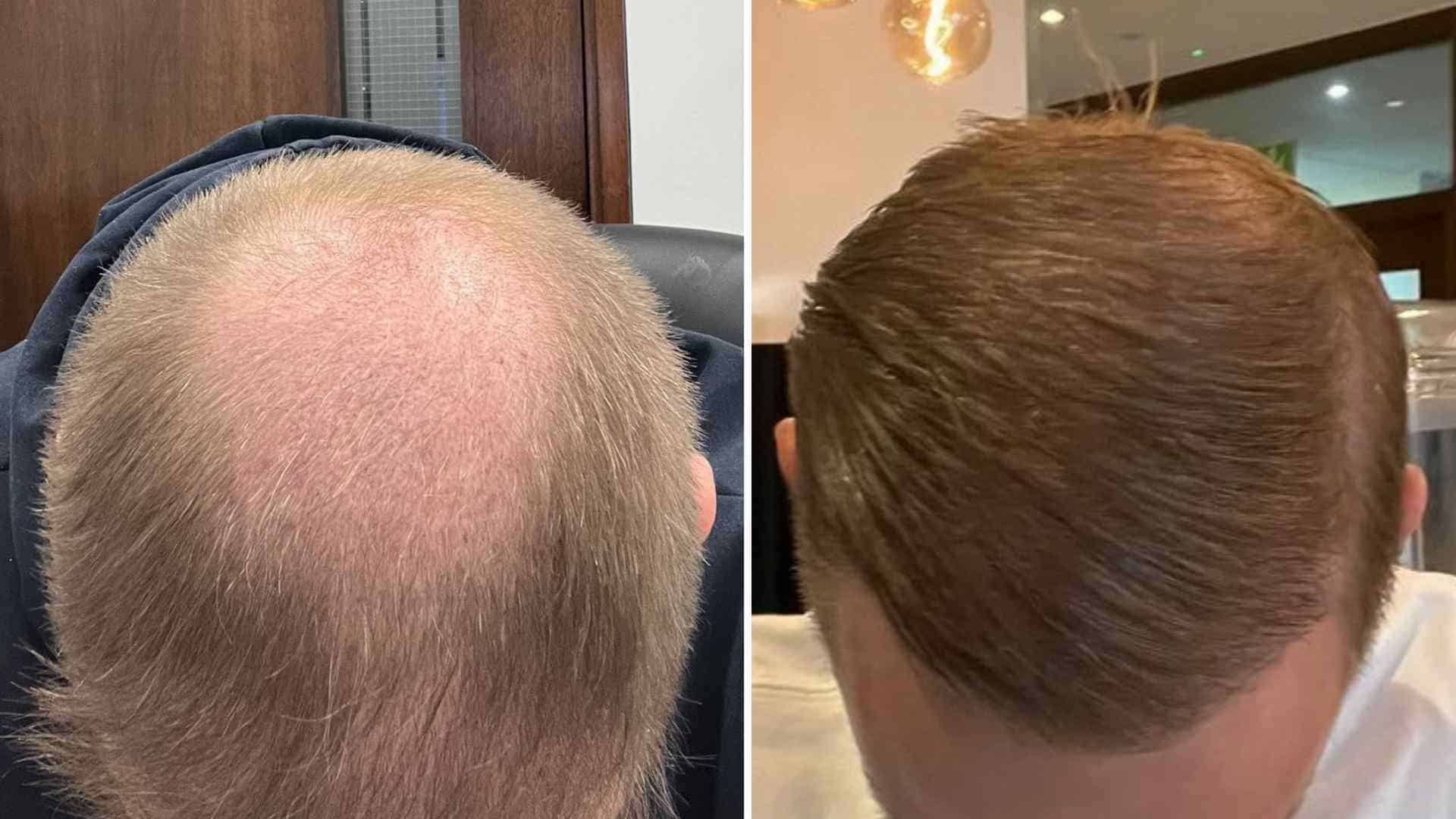 crown hair results