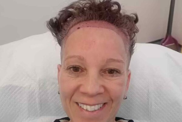 pushed back hairline fix