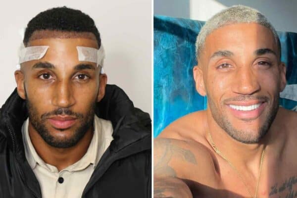 ryan cleary afro hair transplant