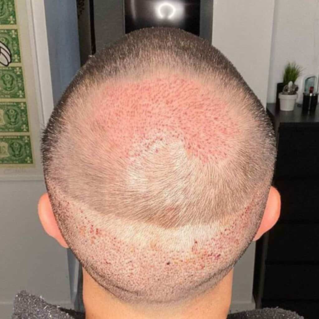 donor area growing back