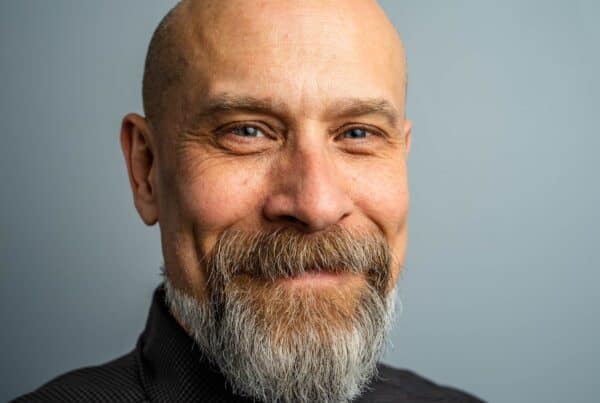 bald before hair transplant