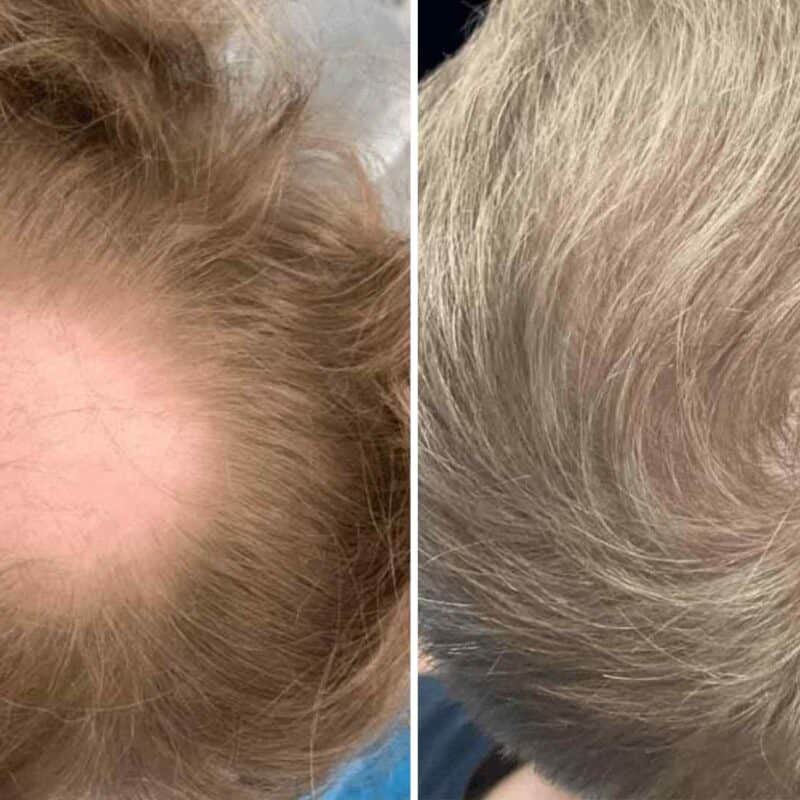 fixing a bald spot on crown