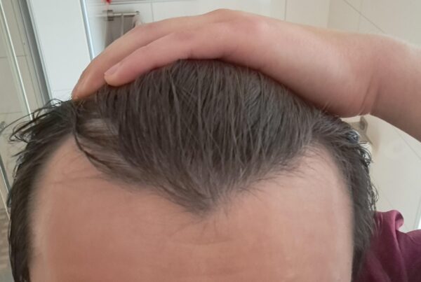 m shaped hairline