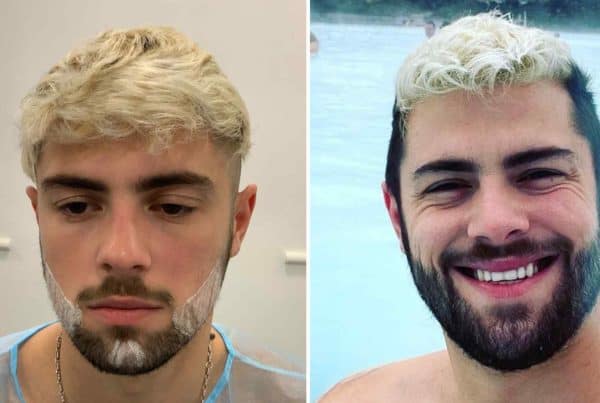 beard transplant recovery timeline