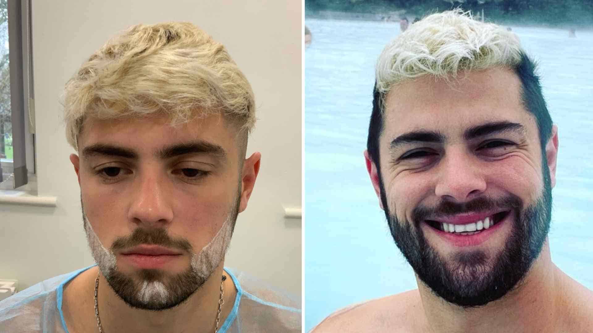 beard transplant stages