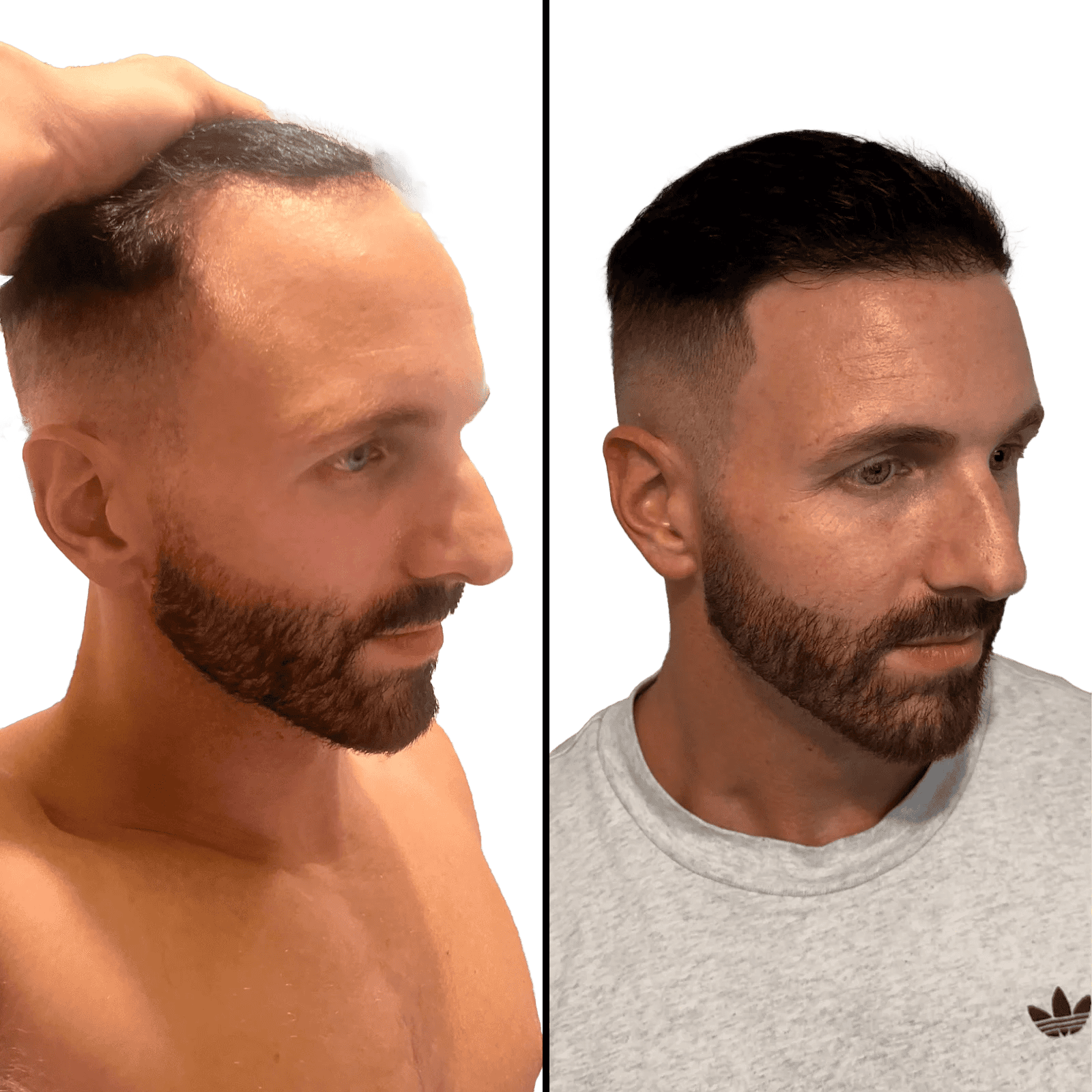patient 2 hair transplant before and after transparent