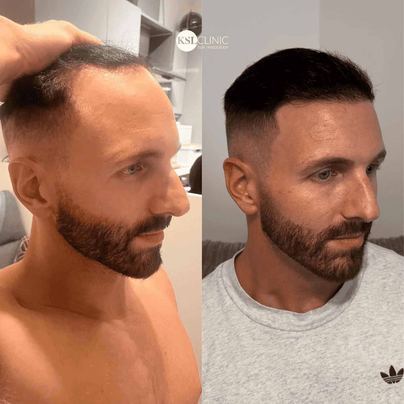 patient 2 hair transplant before and after