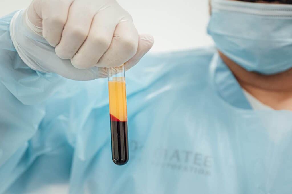PRP After Hair Transplant: Why and the Benefits
