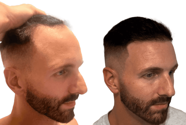why is my hair thinning on the side?