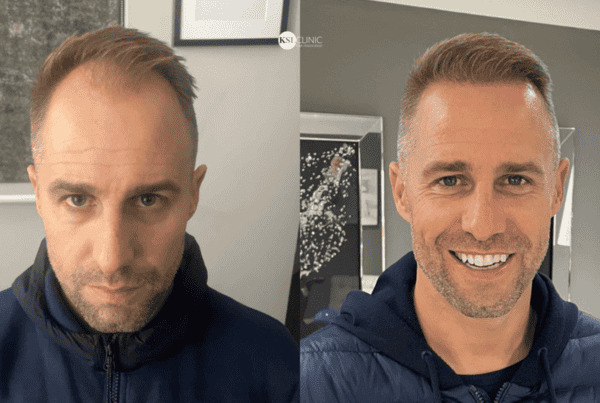 Does a Hair Transplant Actually Work?