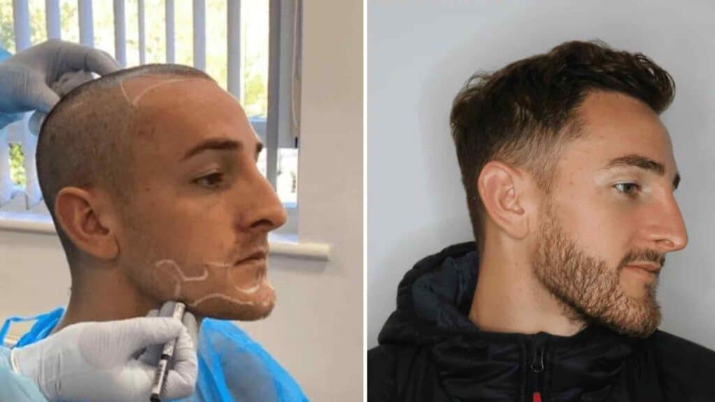 hair receding on one side