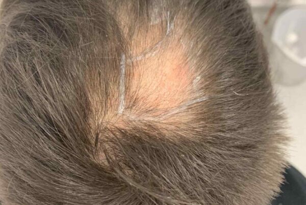 Hair Transplant Help With Lichen Planopilaris?