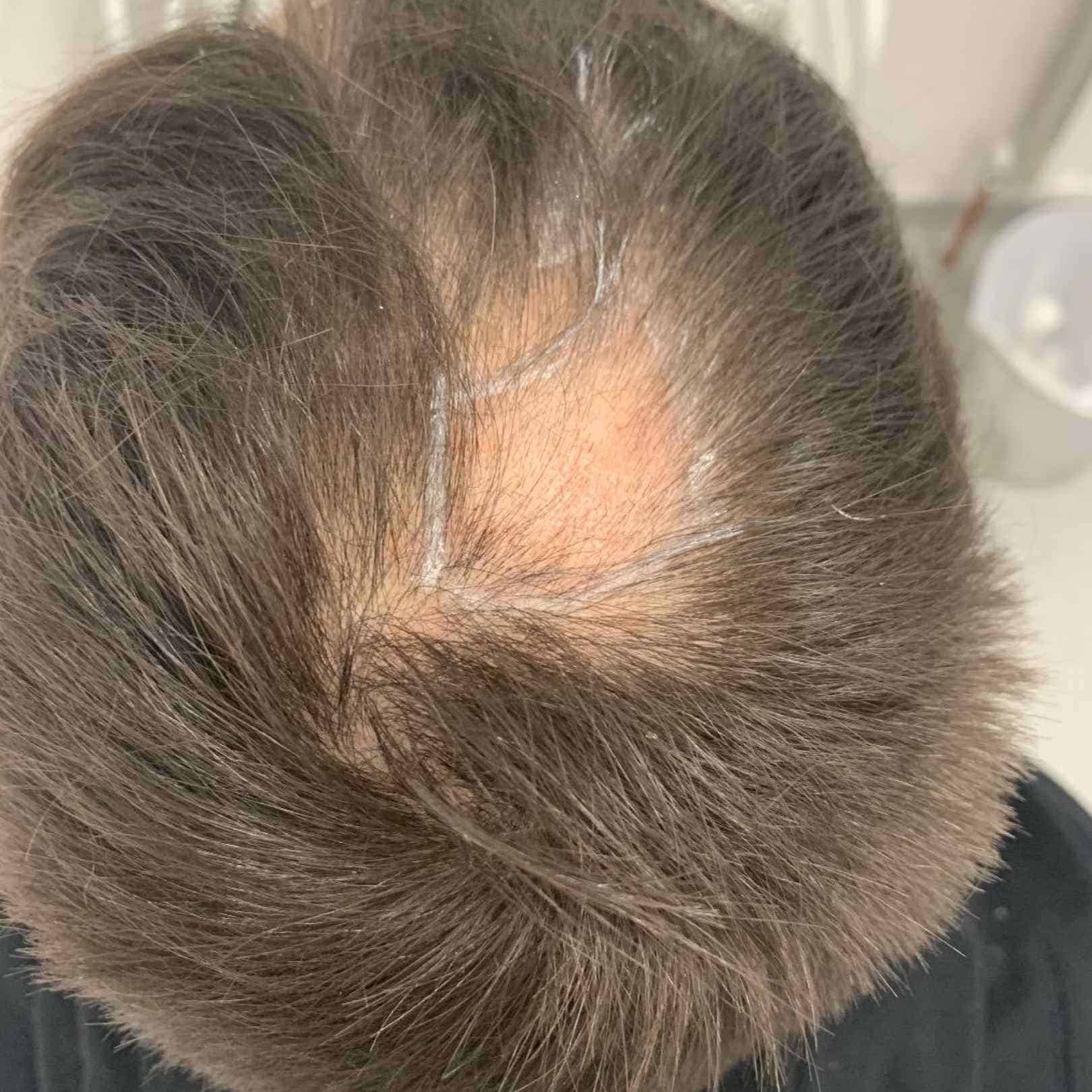 Can a Hair Transplant Help With Lichen Planopilaris?