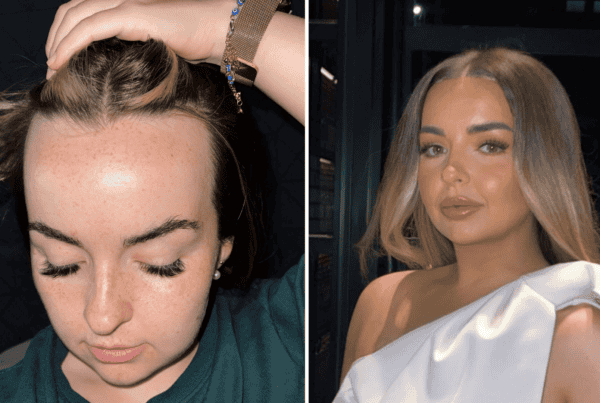 can a hair transplant help with female pattern baldness
