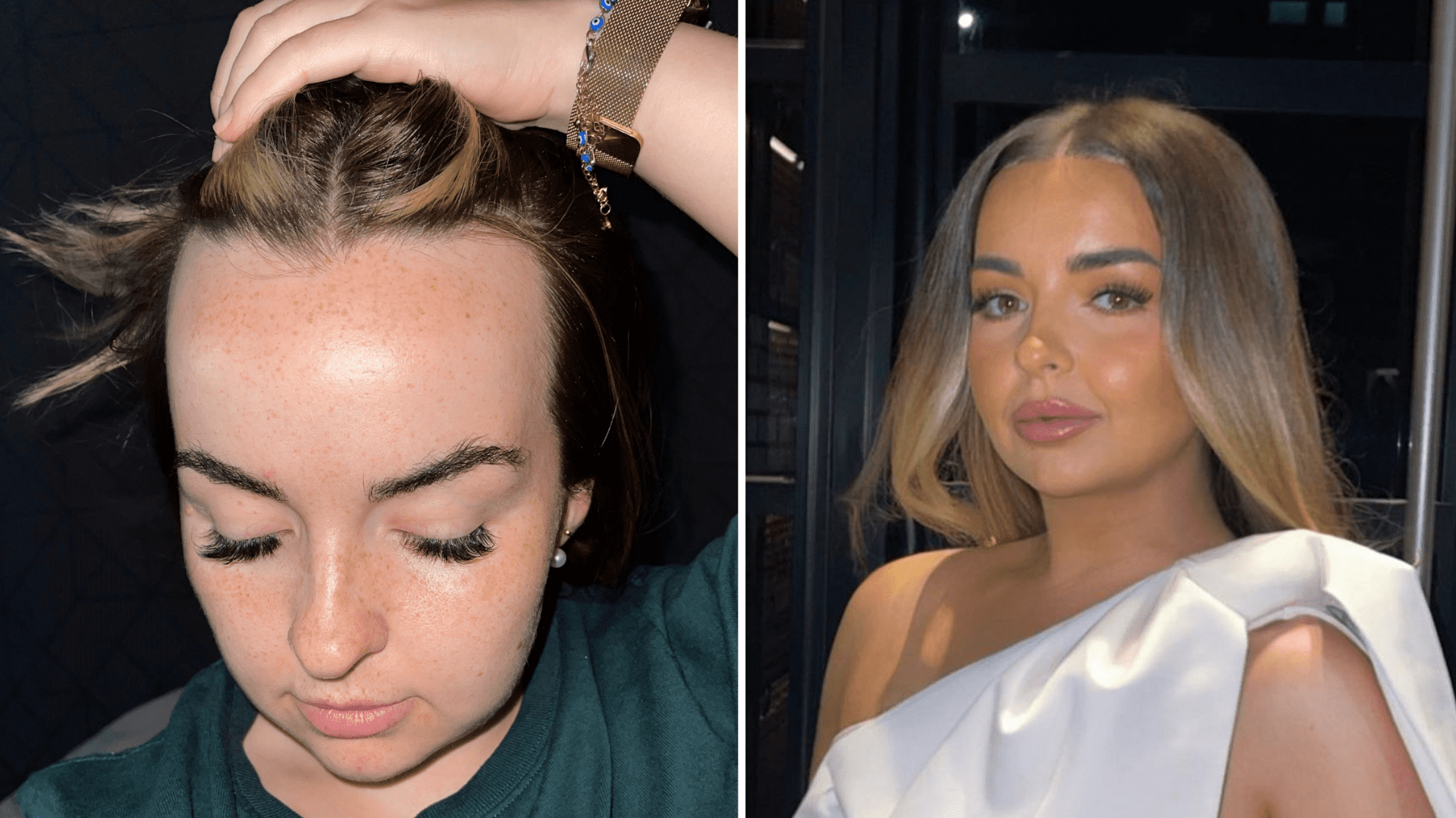 Can a Hair Transplant Help With Female Pattern Baldness?