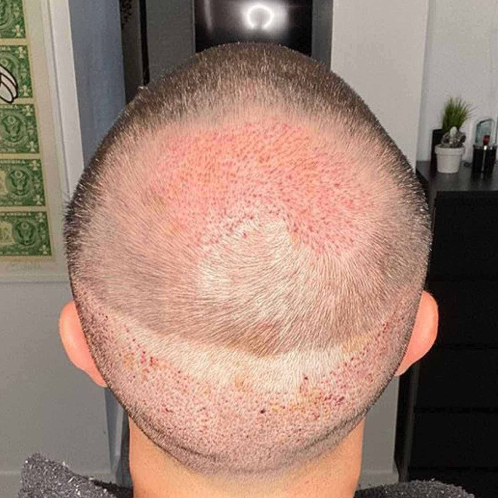 Can a Hair Transplant Help With Scar Repair?