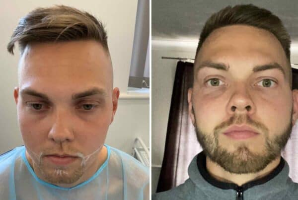 Beard Alopecia Treatment – Can a Hair Transplant Help?