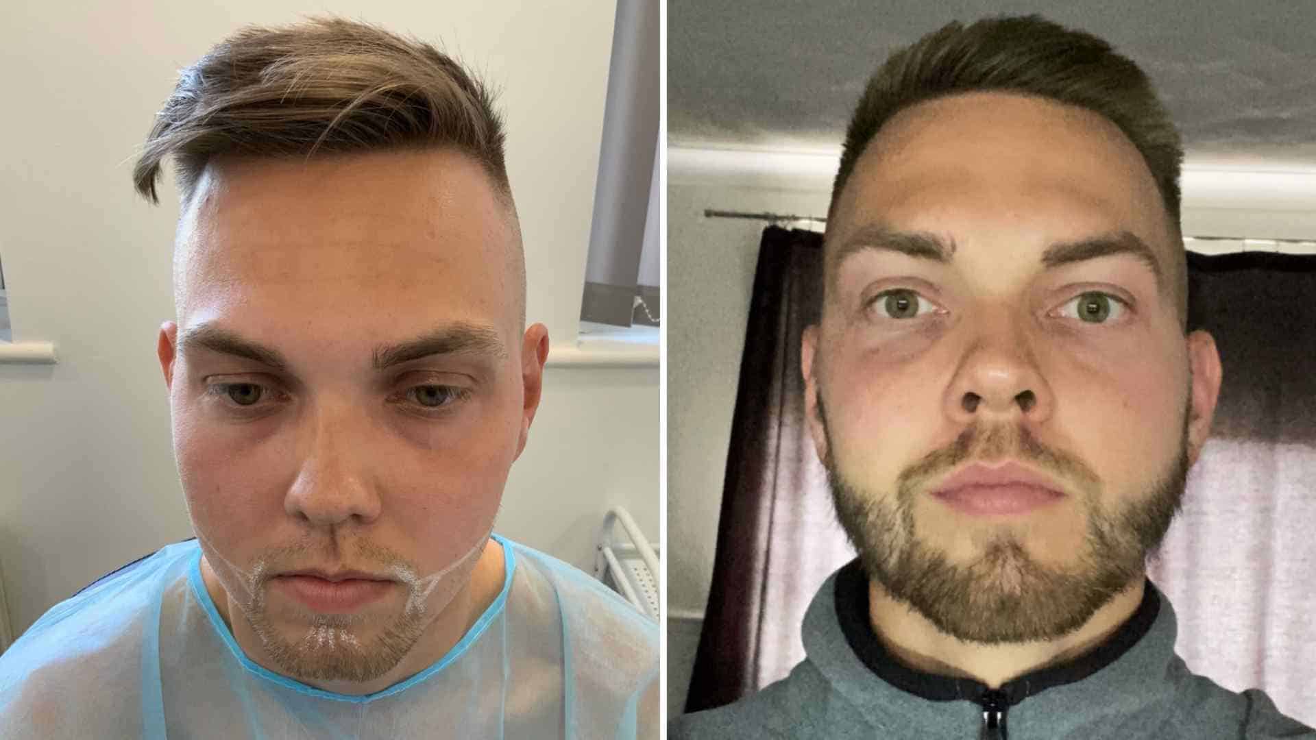 Beard Alopecia Treatment – Can a Hair Transplant Help?