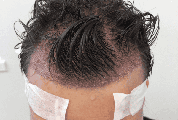 a man on a hair transplant recovery process