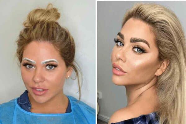 eyebrow transplant cost