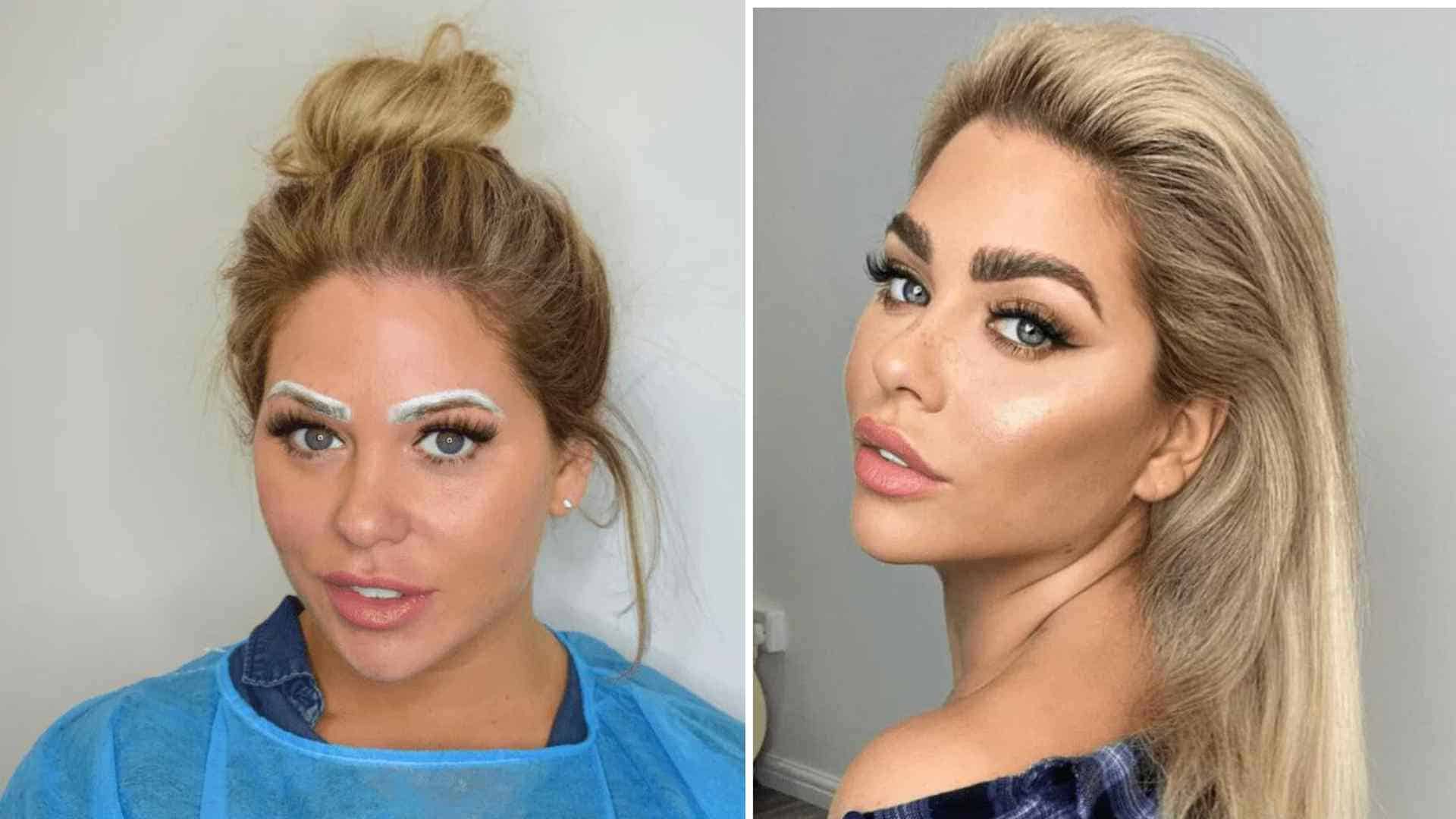 eyebrow transplant cost