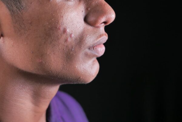 thinning sideburns