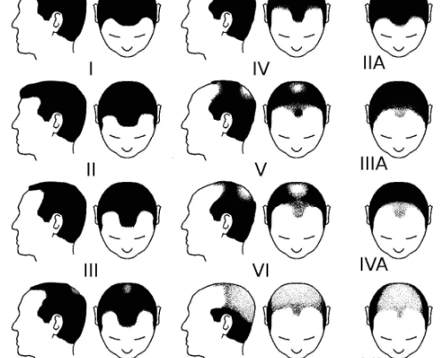 Receding Hairline Stages The Seven Stages of Baldness
