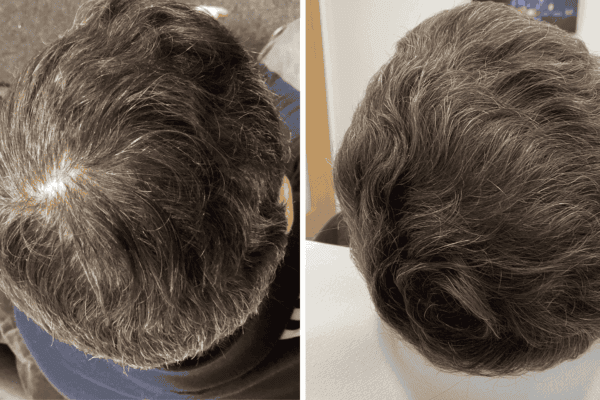 Before and after prp