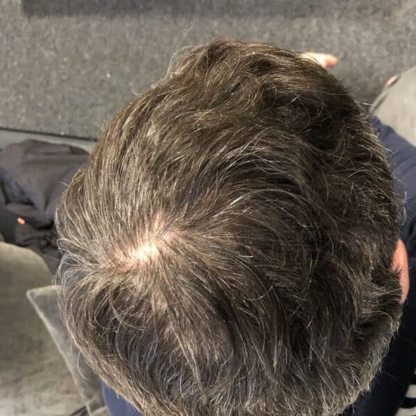 PRP before and after 1