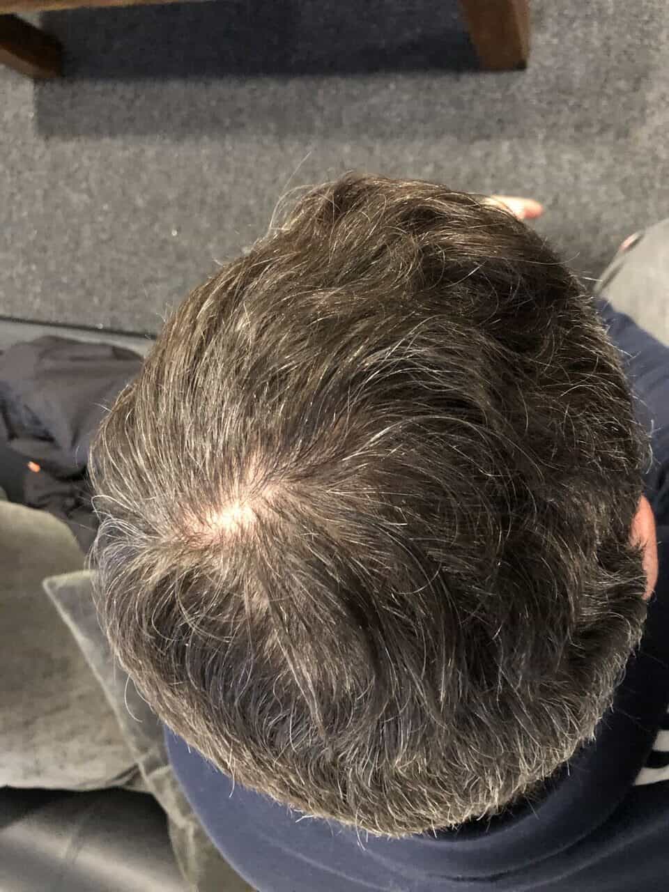 PRP before and after 1