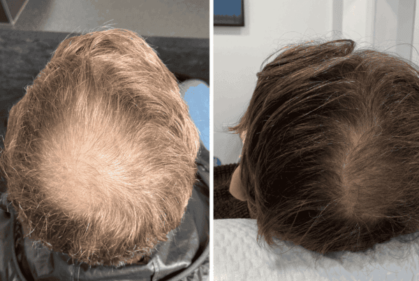how much does prp cost