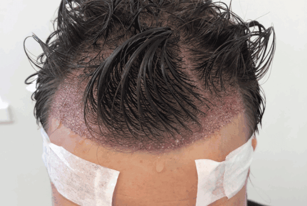 swelling after hair transplant