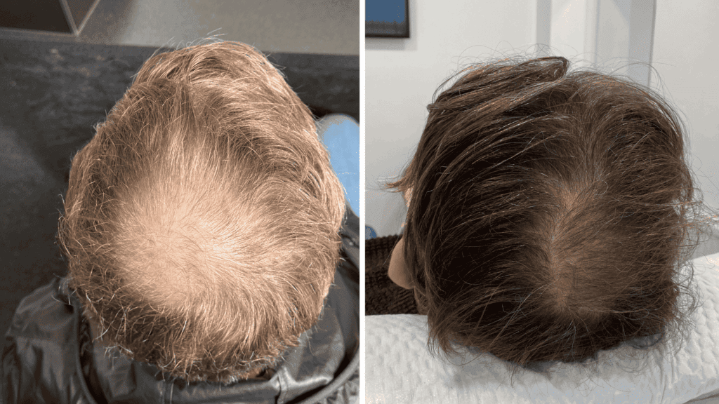 how long do PRP results take