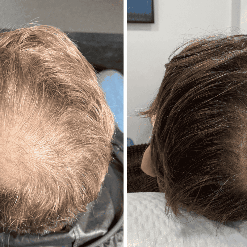 how long do PRP results take