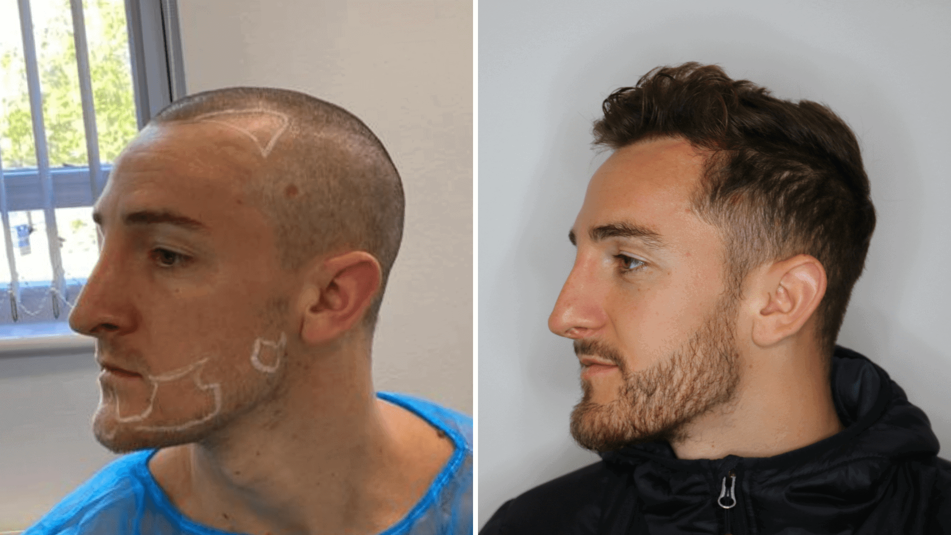 hair transplant in Cambridge