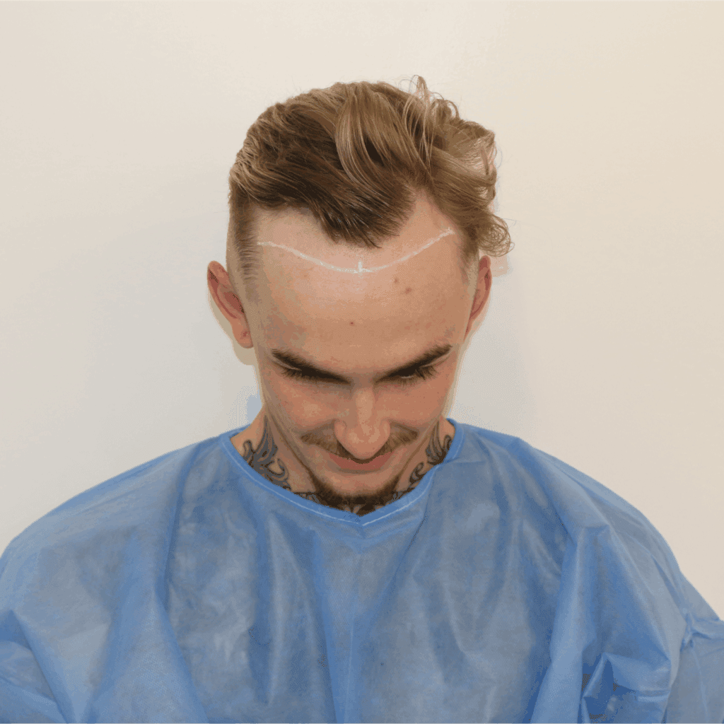 preparing for a hair transplant
