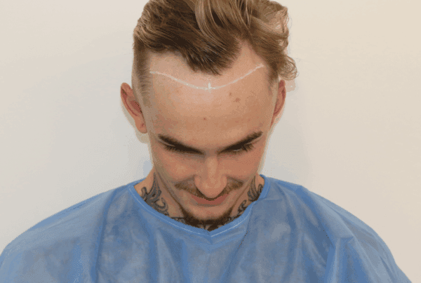 preparing for a hair transplant
